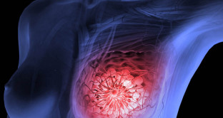 Il Centro di Biotecnologie Molecolari dell'Università di Torino ha scoperto una proteina per migliorare le cure contro il tumore al seno. 