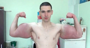 L'ennesima storia di narcisismo social e follia: giovane russo vuole somigliare a Braccio di Ferro e raggiungere 1 milione di follower su Instagram rischiando l'amputazione. 