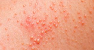 Quali sono i sintomi dell'allergia al nichel e come riconoscerla e intervenire. 