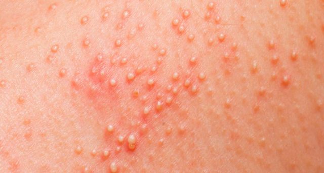 Quali sono i sintomi dell'allergia al nichel e come riconoscerla e intervenire. 