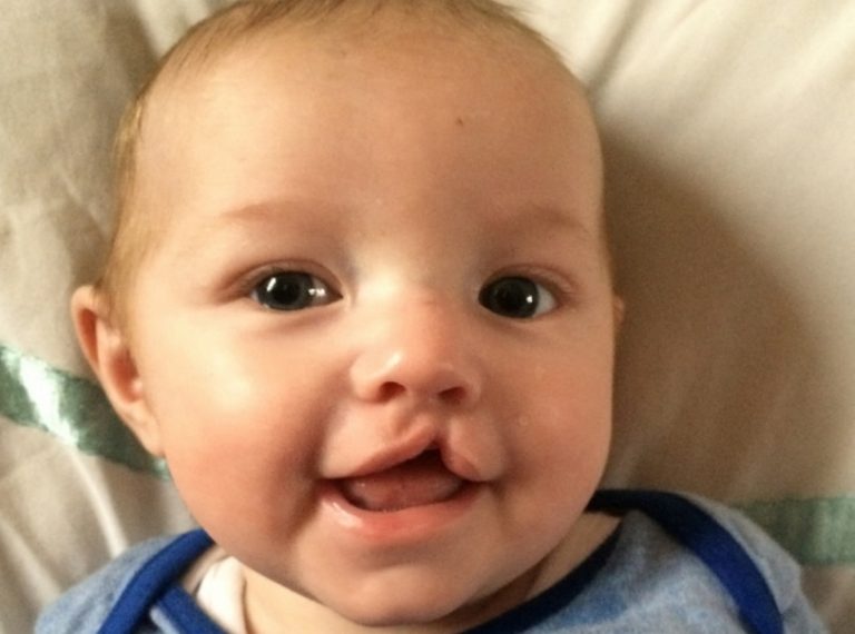 Accertamento invalidità e legge 104, per il minore affetto da labiopalatoschisi, detto comunemente "labbro leporino", l'Inps pubblica le nuove linee guida: ecco cosa cambia.