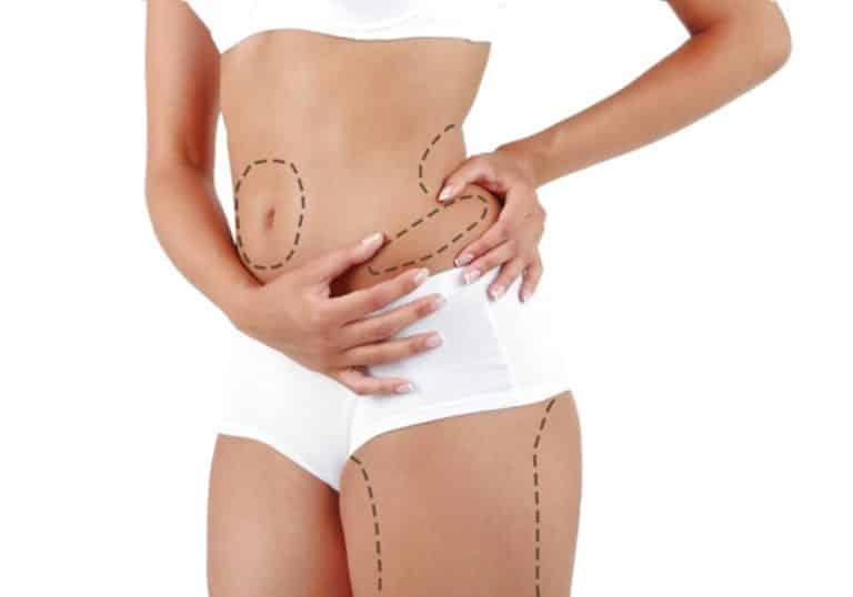 Gli interventi di Liposuzione alle gambe, sono interventi utile a risolvere problemi fisici, non tutte le spese sono detraibile. Vediamo insieme i chiarimenti dell’Agenzia delle Entrate in merito.